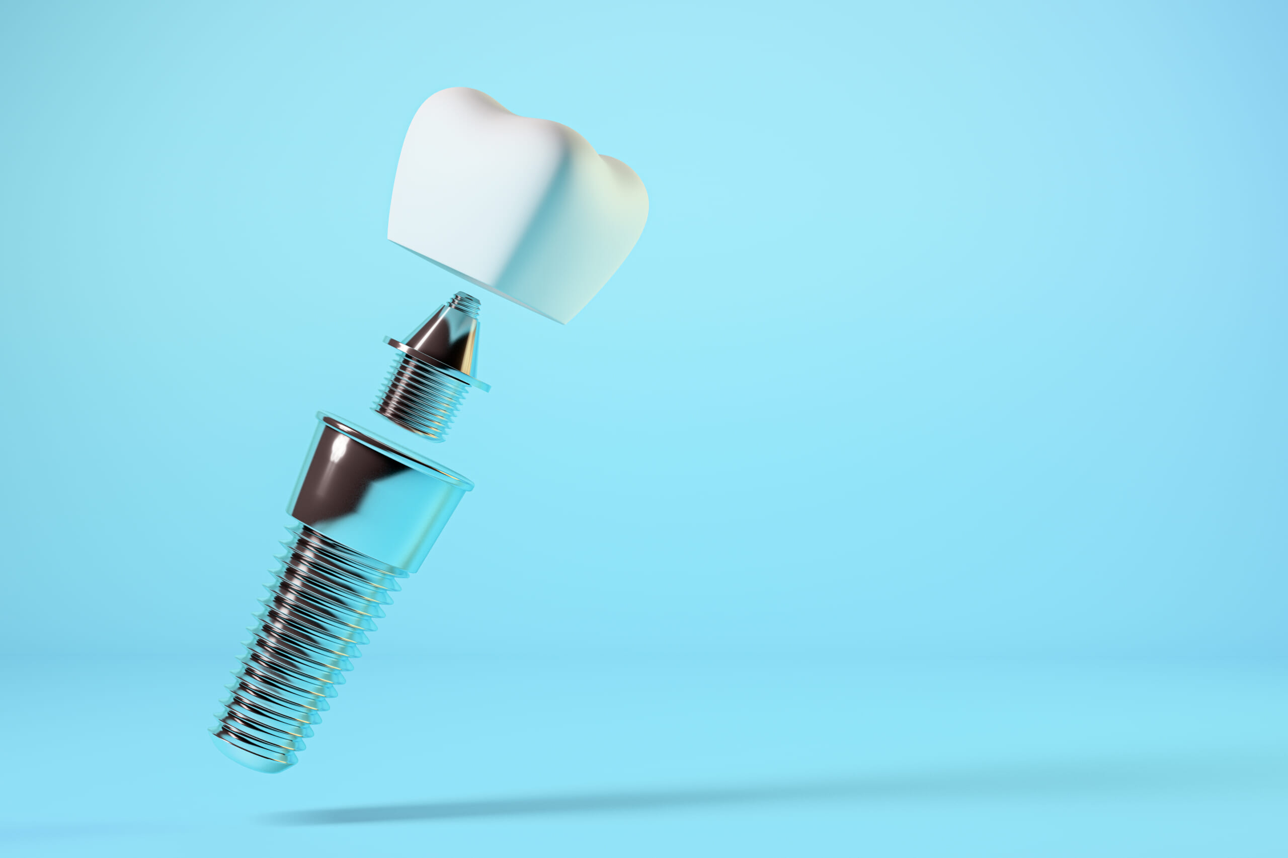 インプラント治療とはどのようなものか？